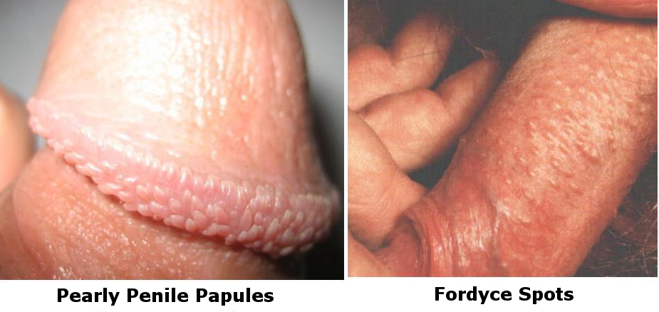 Fordyce Spots On Head Of Penis 110