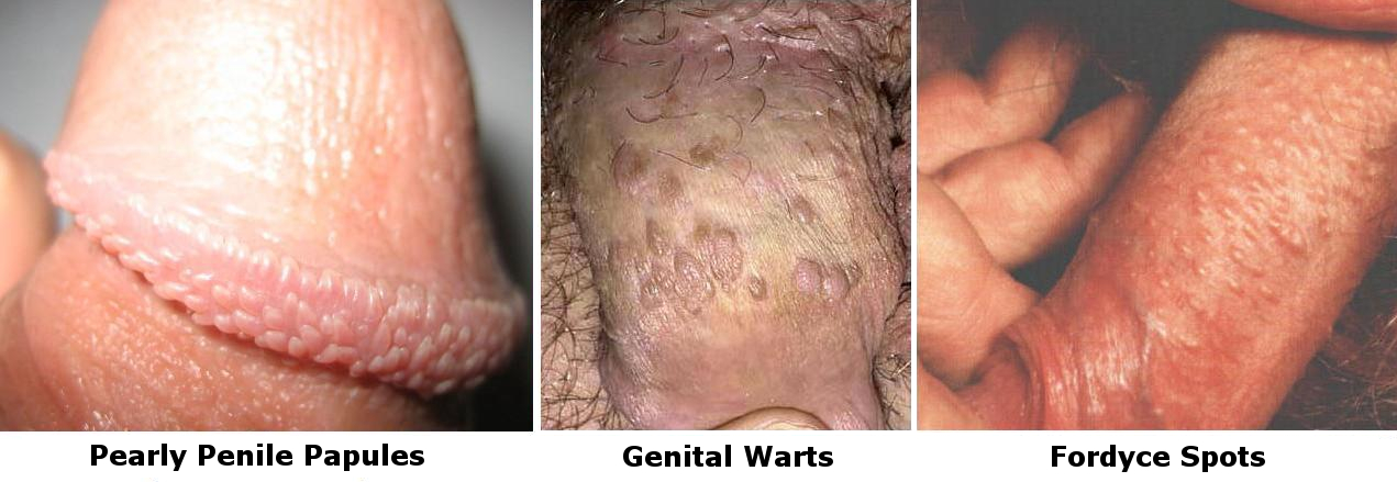 HOME Pearly Penile Papules PPP.